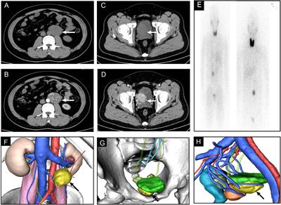 A rare case report of multifocal para-aortic and para-vesical paragangliomas